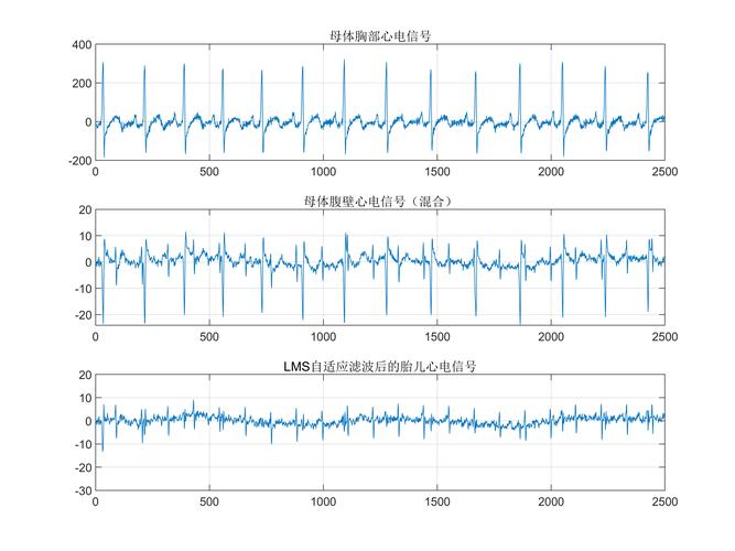 Matlab源码如何实现胎儿心电信号的特征提取？