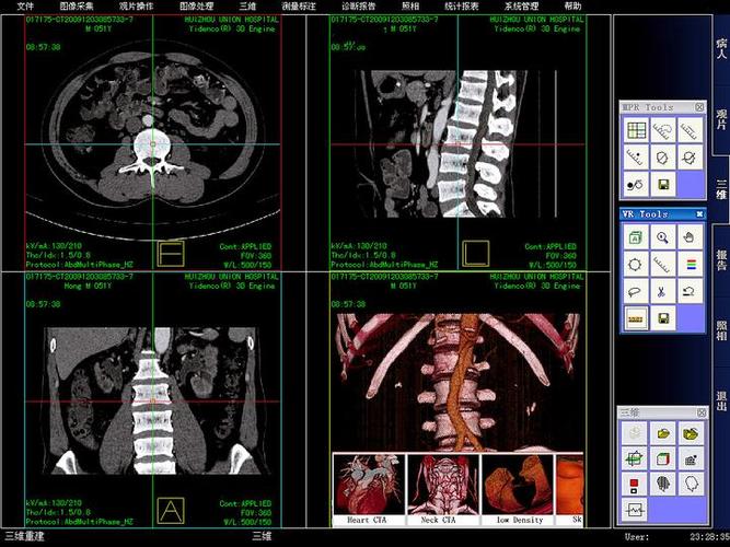 医院影像PACS系统如何实现三维重建技术？