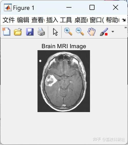 如何利用图像检测结合多种特征与支持向量机在Matlab中实现脑MRI肿瘤检测与分类？