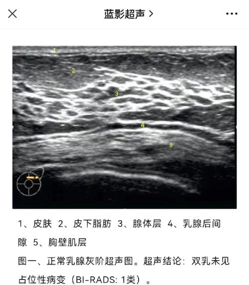 Kaggle竞赛中，如何进行超声图像乳腺癌有效分割？