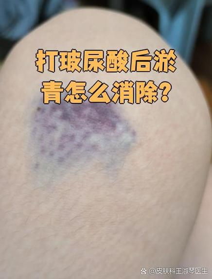 打玻尿酸后为什么会形成淤青？
