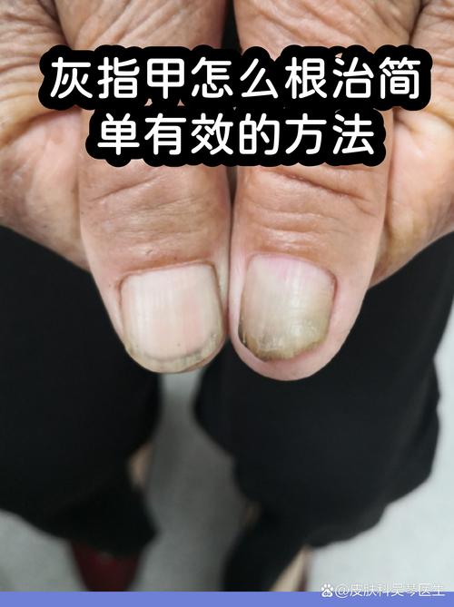 百度SEO优化如何帮助彻底根除灰指甲？