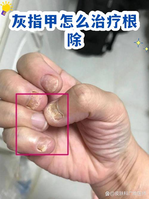百度SEO优化如何帮助彻底根除灰指甲？